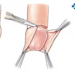 Cắt bao quy đầu là gì? Hiểu rõ hơn về lợi ích và phương pháp cắt bao quy đầu 