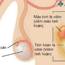 Chia sẻ từ A – Z thông tin về viêm mào tinh hoàn là gì? Nguyên nhân và cách điều trị hiệu quả