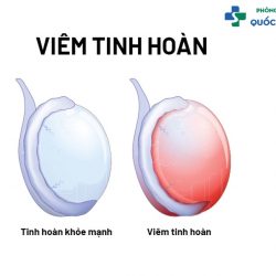 Cùng bác sĩ chuyên khoa tư vấn viêm tinh hoàn uống thuốc gì?