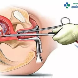 Cách phá thai 1 tháng tuổi an toàn và phổ biến hiện nay