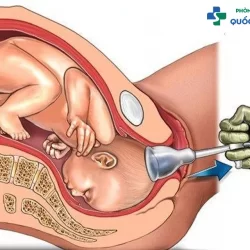 Chi tiết về cách phá thai an toàn và tốt hiện nay