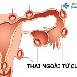 [Góc giải đáp] Cách phá thai ngoài tử cung an toàn