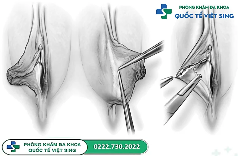 Cắt môi bé là gì? Vì sao nên lựa chọn?