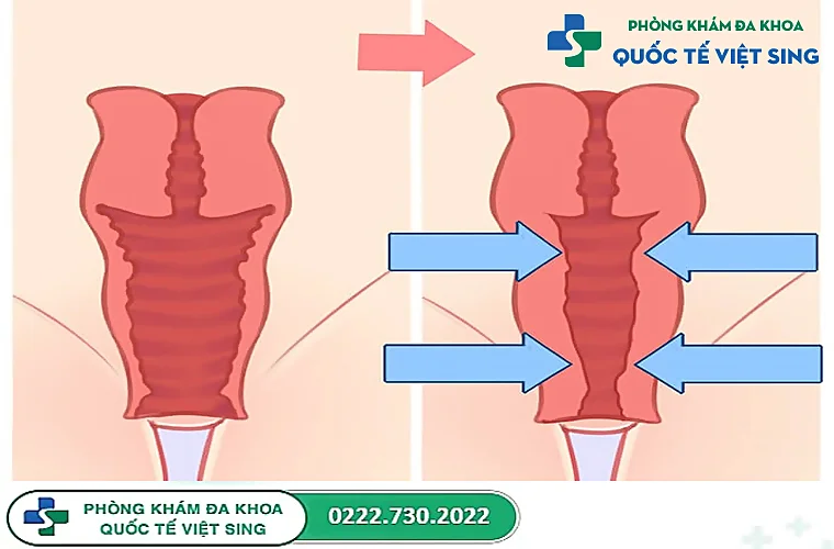 Thu hẹp âm đạo vì sao nên thực hiện?