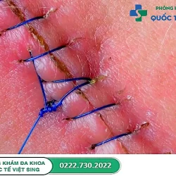 Các cách điều trị vết khâu tầng sinh môn bị sưng đau