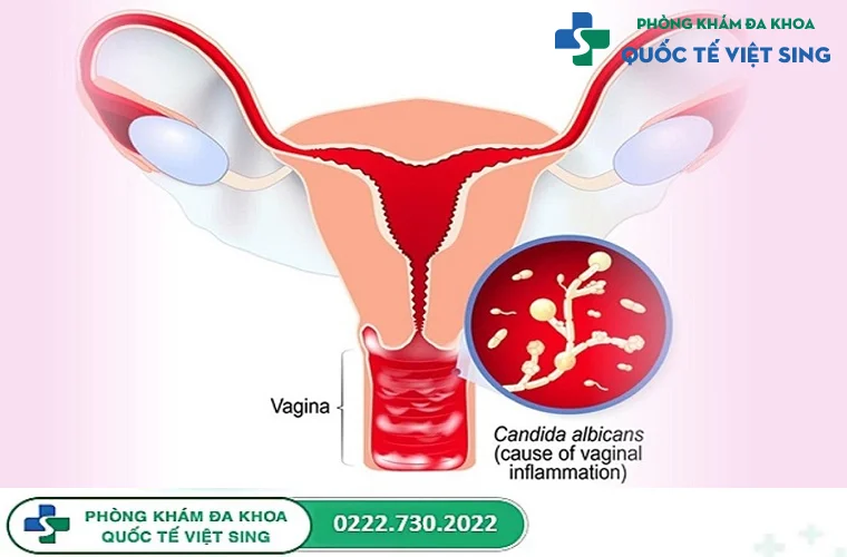 Không thể bỏ qua 5 nguyên nhân gây viêm âm đạo phổ biến