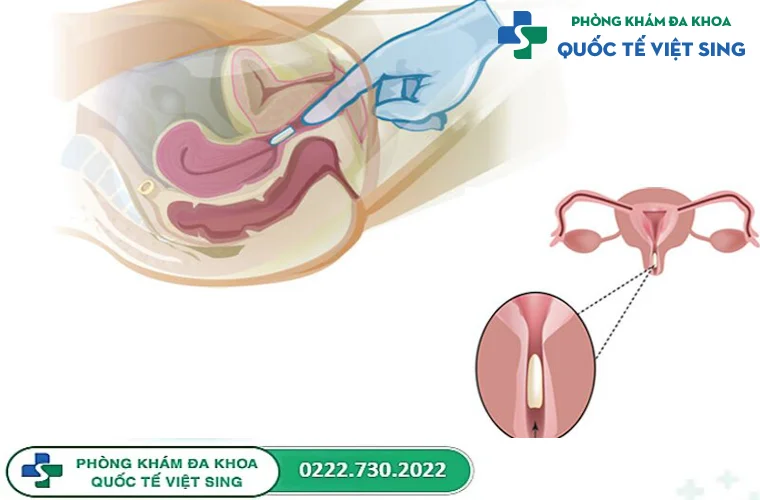 Giải đáp: Hướng dẫn cách đặt thuốc vào âm đạo chính xác