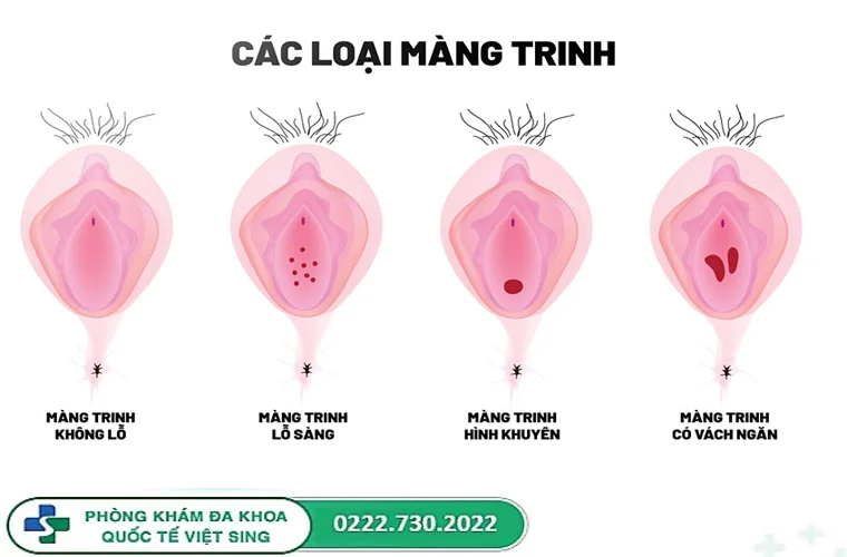 Màng trinh và những điều bạn cần biết