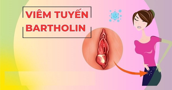 Chữa viêm tuyến Bartholin Bắc Ninh: Khi đau rát vùng kín không còn là chuyện nhỏ
