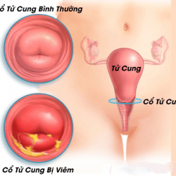 Viêm cổ tử cung Bắc Ninh – Nguyên nhân, dấu hiệu và hướng điều trị an toàn hiện nay