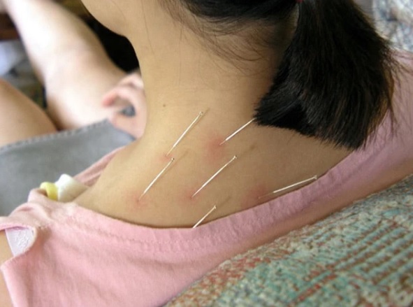 Châm cứu bị chảy máu có sao không? Cảnh báo những trường hợp cần đi khám ngay